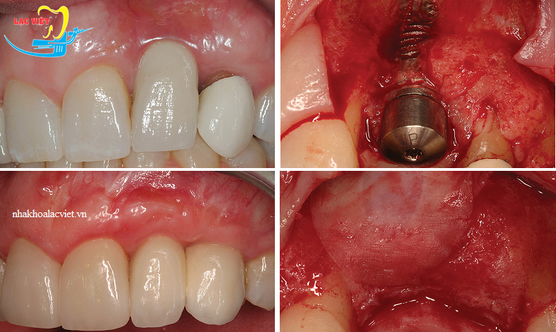 Viêm, nhiễm trùng là những vấn đề thường gặp của răng implant