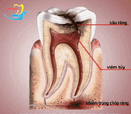 làm cách nào để hết sâu răng khi bị viêm tủy