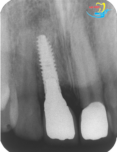 Hình ảnh qua chụp x-quang cấy ghép implant thay thế cho mất một răng