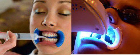 4 nguyên nhân khiến răng trở nên nhạy cảm