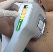  Sử dụng công nghệ MiraDry để phá hủy các tuyến mồ hôi 