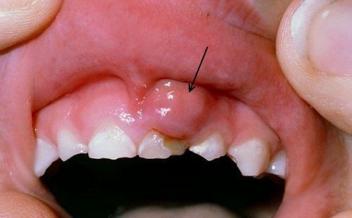 Tác hại của bệnh viêm nướu răng