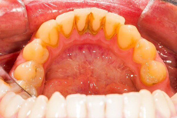 bệnh viêm nha chu không chỉ gây mất răng