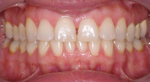 Tác hại của bệnh thiếu sản men răng