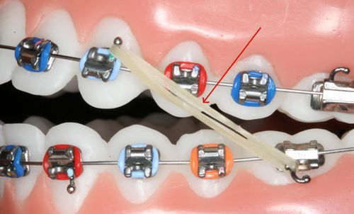 Phương pháp điều trị tình trạng răng mọc chen lấn nhau - Nha khoa Đăng Lưu