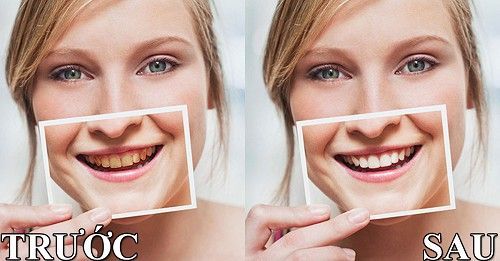 Chăm sóc miệng và những điều nên biết