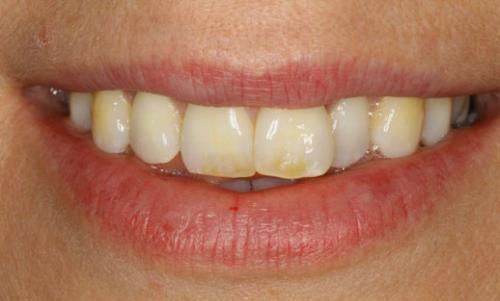 Bọc răng sứ cho tình trạng thiếu sản men răng - Nha khoa Đăng Lưu