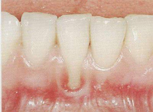 Nguyên nhân gây bệnh thiếu sản men răng