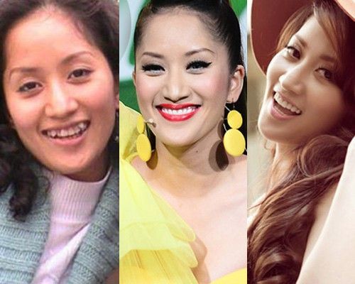 Khánh Thy xinh đẹp hơn nhờ niềng răng