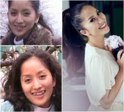 Khánh Thy xinh đẹp hơn nhờ niềng răng