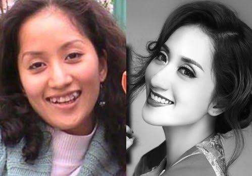 Khánh Thy xinh đẹp hơn nhờ niềng răng