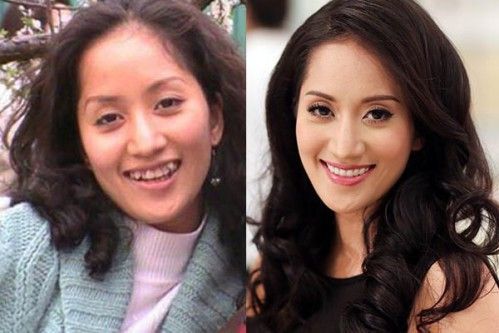 Khánh Thy xinh đẹp hơn nhờ niềng răng - Nha khoa Đăng Lưu