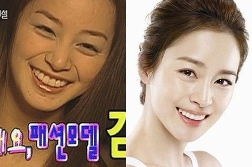 Kim Tae Hee lột xác nhờ niềng răng