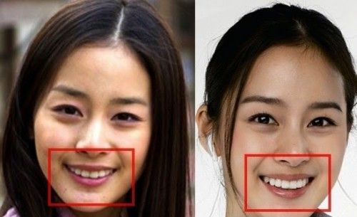 Những mỹ nhân Hàn từng thẩm mỹ răng miệng