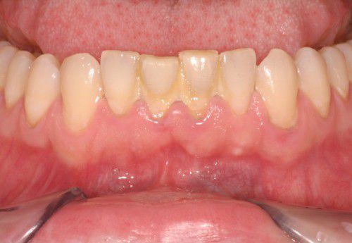 Lấy cao răng là cách điều trị viêm lợi hiệu quả - Nha khoa Đăng Lưu
