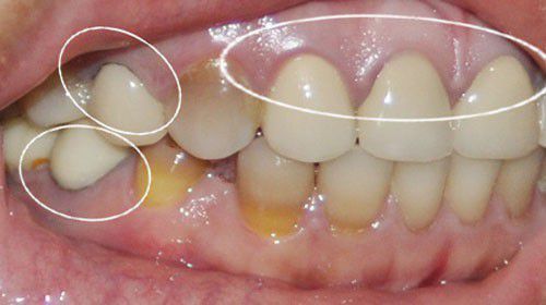 Các loại nhiễm màu răng trong quá trình phát triển