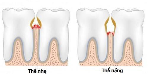 Xỉa răng ảnh hưởng thế nào tới sức khỏe răng miệng - Nha khoa Đăng Lưu