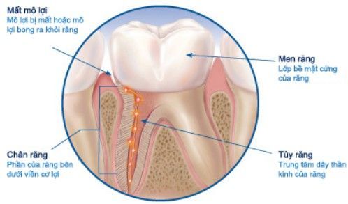 Nguyên nhân khiến răng trở nên nhạy cảm