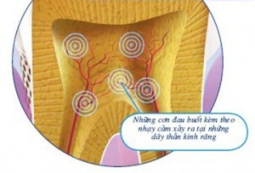 4 nguyên nhân khiến răng trở nên nhạy cảm - Nha khoa Đăng Lưu