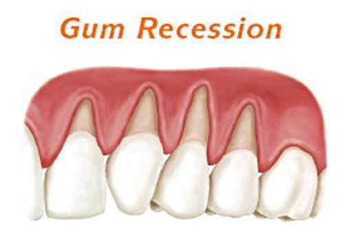 Các giai đoạn phát triển của bệnh tụt lợi - Nha khoa Đăng Lưu