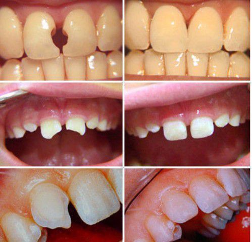 Tại sao cần điều trị viêm tủy chân răng