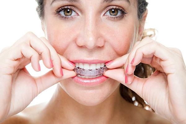 Niềng răng Invisalign ở Việt nam như thế nào