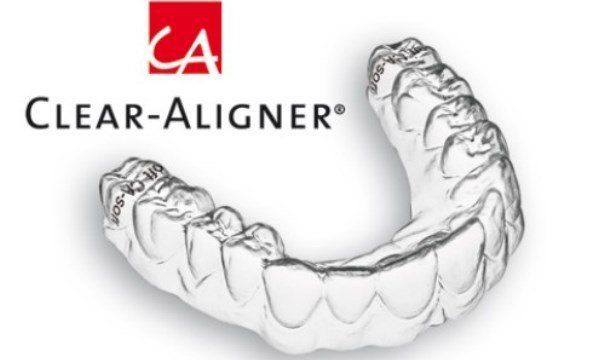 Niềng răng không mắc cài Clear Aligner - Nha khoa Đăng Lưu