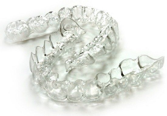 nieng-rang-khong-mac-cai-clear-aligner-2