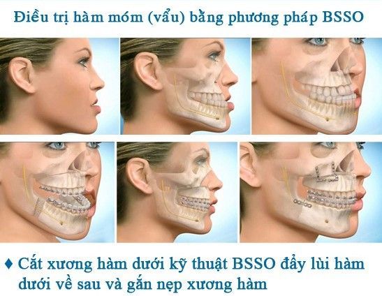  phẫu thuật hàm vẩu hiệu quả với kỹ thuật Bsso