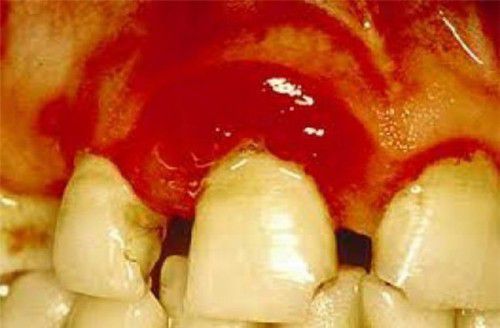 Phương pháp tạm thời ngăn ngừa chảy máu chân răng - Nha khoa Đăng Lưu
