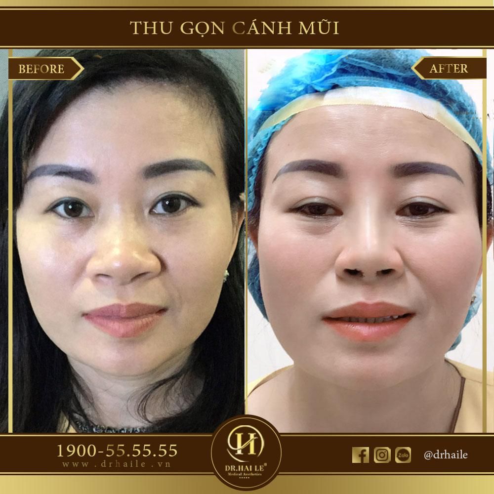 thu gon canh mui nhung dr hai le 2