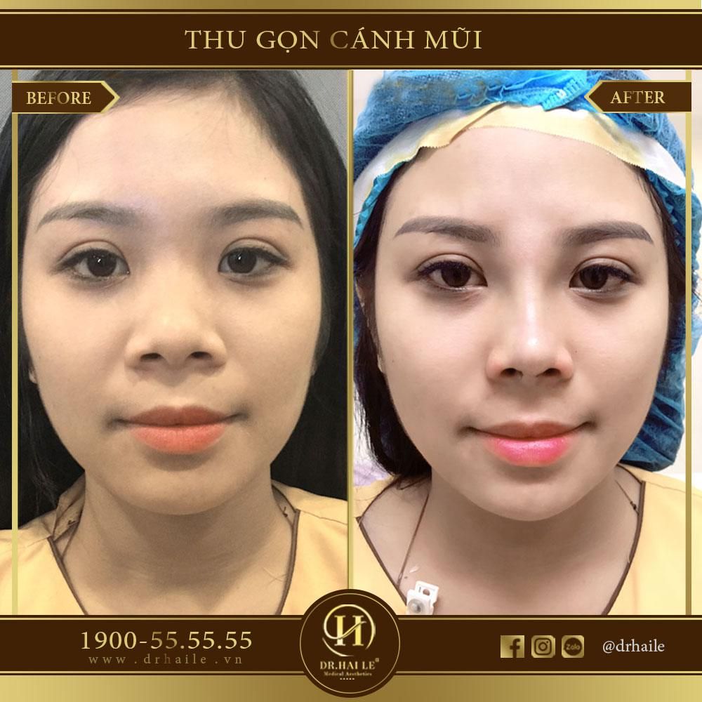 thu gon canh mui nhung dr hai le 4