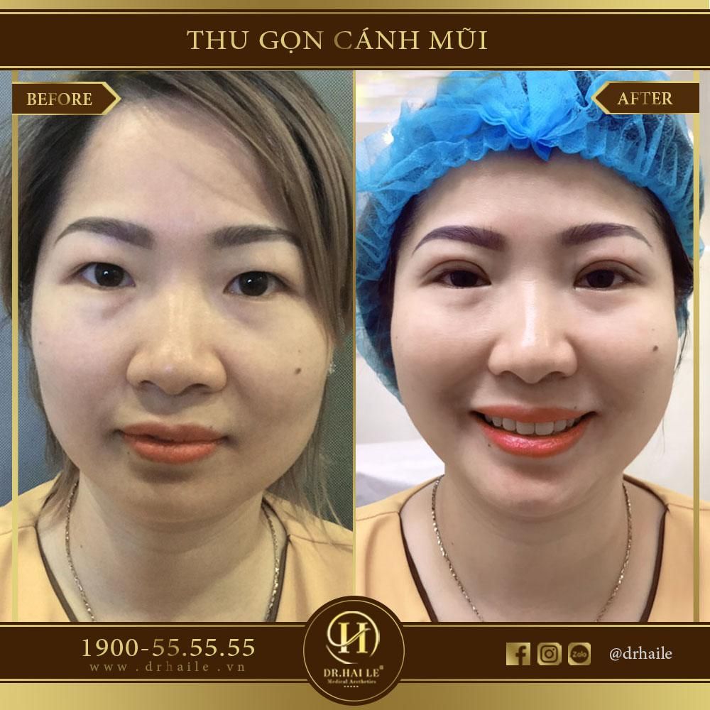 thu gon canh mui nhung dr hai le