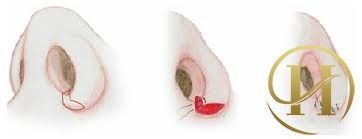 thu gọn cánh mũi