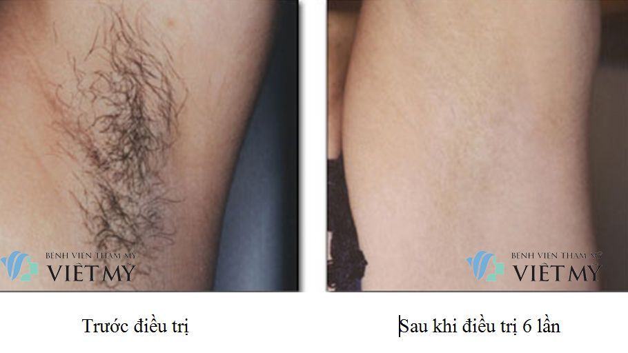 triet long khong dau, triệt lông công nghệ cao, triệt lông không đau công nghệ mới, triệt lông vĩnh viễn, triet long vinh vien