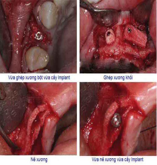 Tác hại của bệnh viêm nướu răng - Nha khoa Đăng Lưu