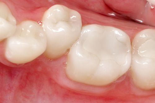 Trám răng cho tình trạng thiếu sản men răng - Nha khoa Đăng Lưu