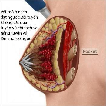 nâng ngực nội soi vết mỗ nách, nang nguc noi soi vet mo nach, nâng ngực o đâu, nang nguc o dau, nang nguc o dau an toan, nâng ngực ở đâu an toàn