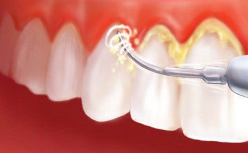 Lấy cao răng là cách điều trị viêm lợi hiệu quả