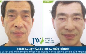 Trẻ hóa toàn diện khuôn mặt cho người có tuổi - Bệnh viện thẩm mỹ JW Hàn Quốc