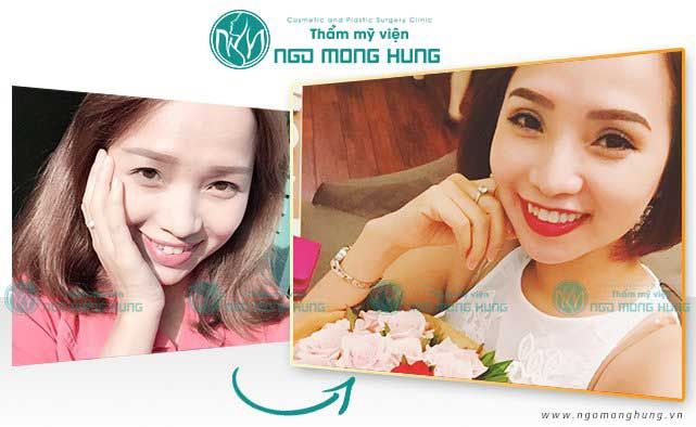 Cắt mí mắt kiêng ăn gì