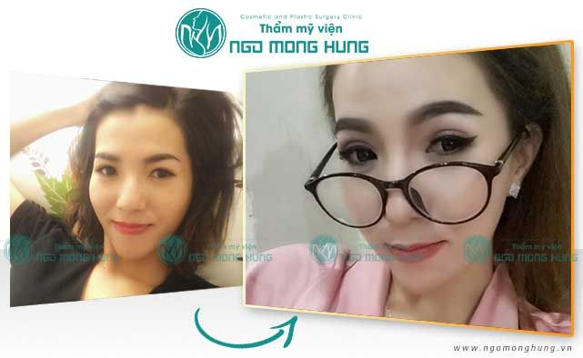 Cắt mí mắt kiêng ăn gì