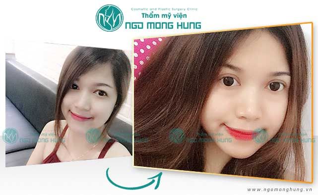 Cắt mí mắt kiêng ăn gì - Bs Ngô Mộng Hùng