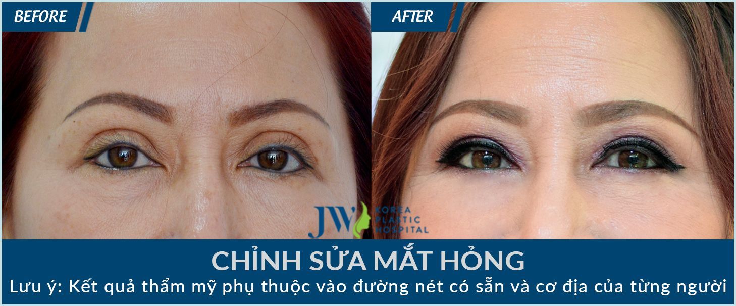 Làm sao để tránh những biến chứng khi cắt mí mắt