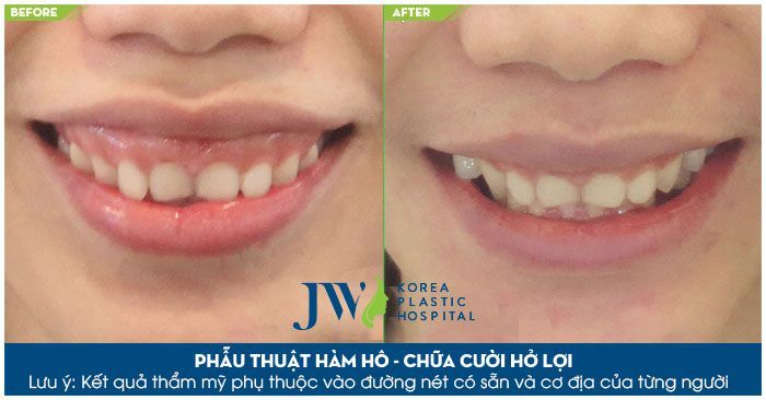 Kết hợp chữa trị hàm hô và hở lợi để khách hàng có được hàm răng đẹp, nụ cười xinh tại JW
