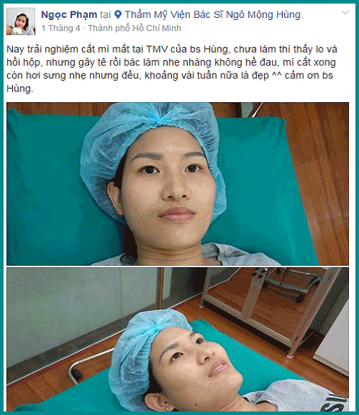 Cắt mí mắt kiêng ăn gì