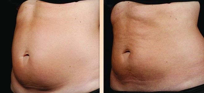 Giảm mỡ Sculpsure giá bao nhiêu tiền