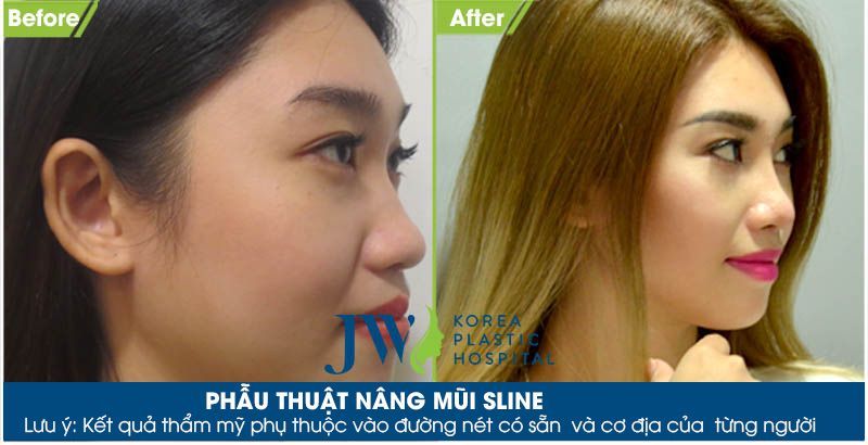 Nâng mũi Hàn Quốc có tốt không