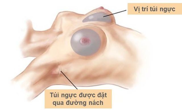 Mô phỏng phương pháp nâng ngực nội soi