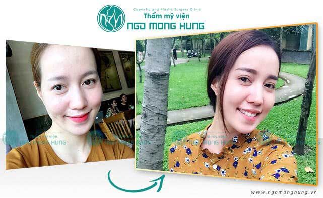 Hiện tượng sụp mí mắt